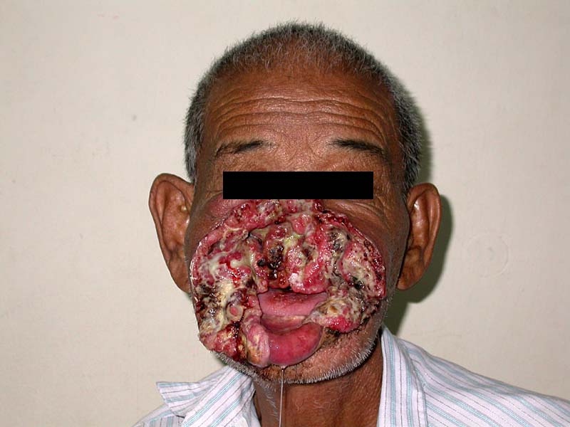 This chronic condition is not contagious, meaning it can't be transmitted. Neglected Facial Ulceration